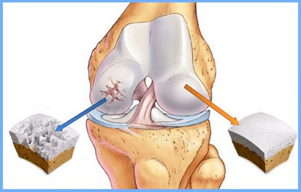 The knee joint is normal and affected by arthrosis