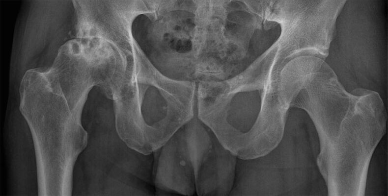 Changing the shape of the hip joint arthrosis on x-ray