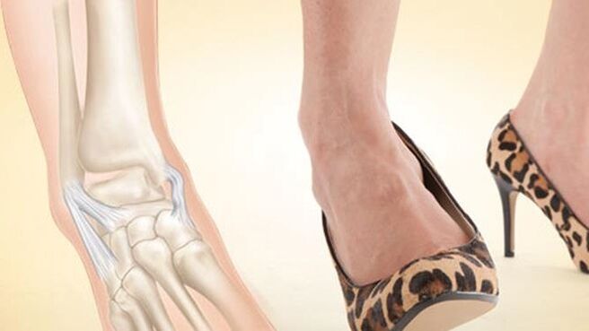 wearing shoes with heels as a cause of ankle arthrosis