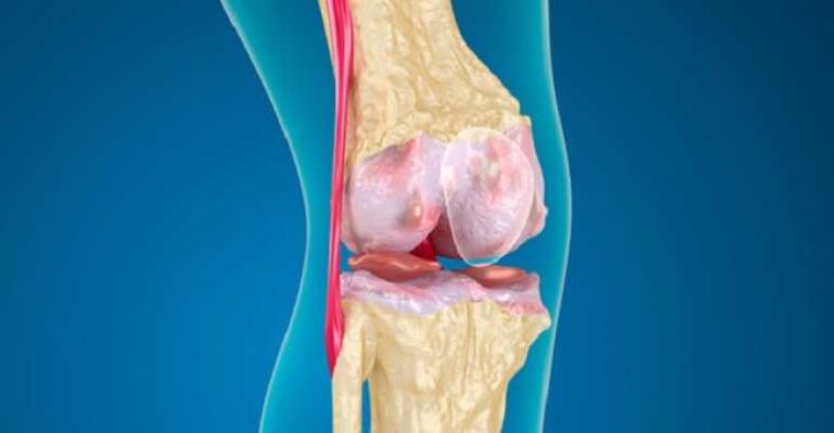 Arthrosis of the knee joint disease, which causes the destruction of cartilage in the joints