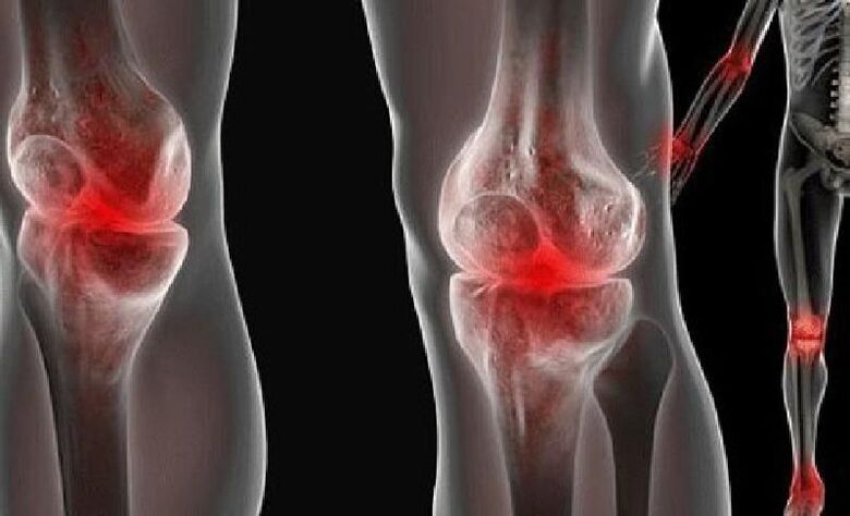 Symptoms of joint gonarthrosis