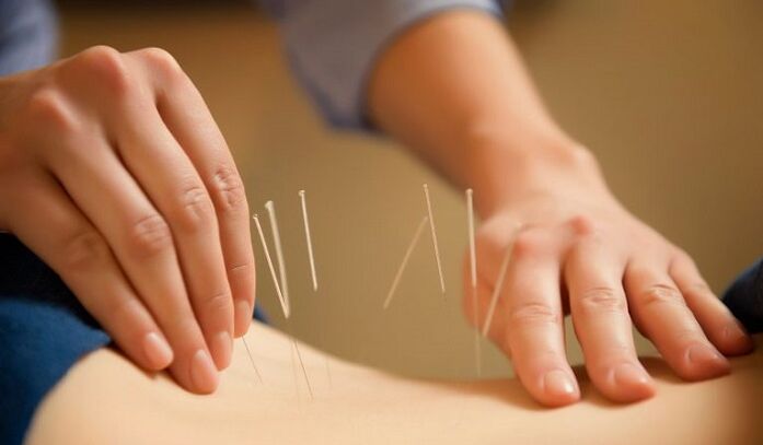 Acupuncture to treat back pain