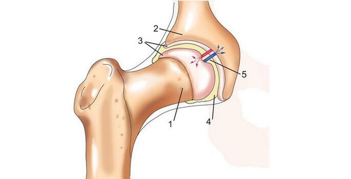 hip joints and arthrosis