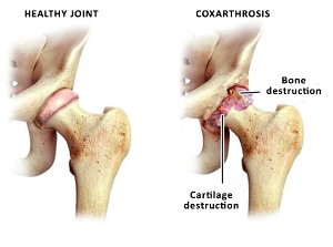 the comparison of a healthy joint, and zustavas hip